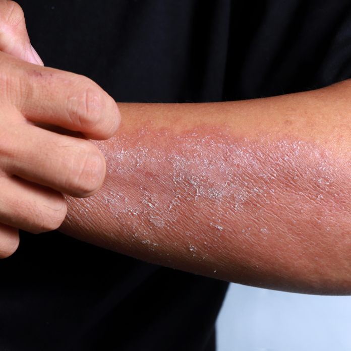 Is it actinic keratosis, or do you just have dry skin